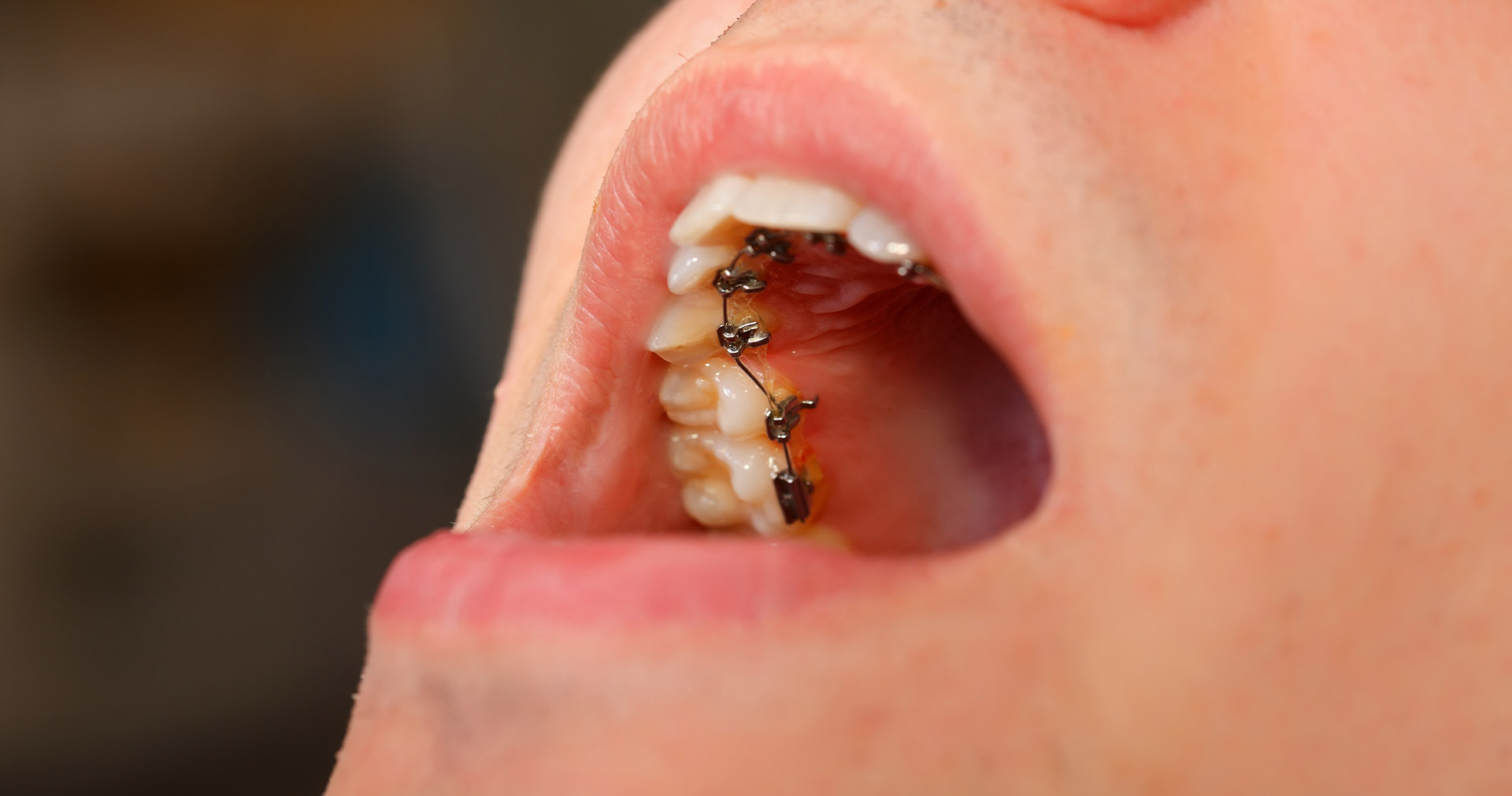 Lingual Braces in Jackson Heights